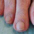 Онихомикоз ногтей – лечение, препараты